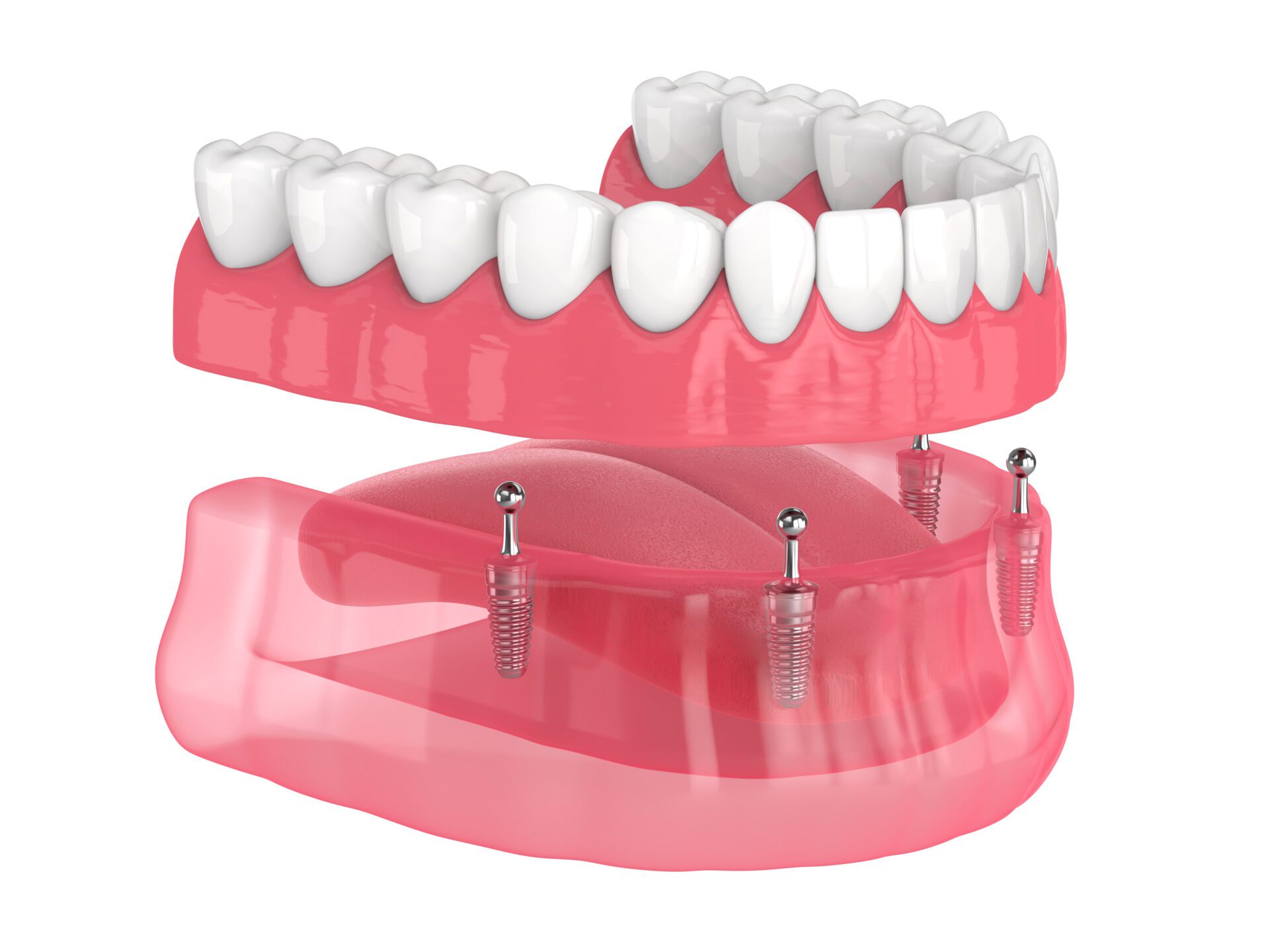 All-on-4 removable, implants supported, overdenture installation in Ocala, FL