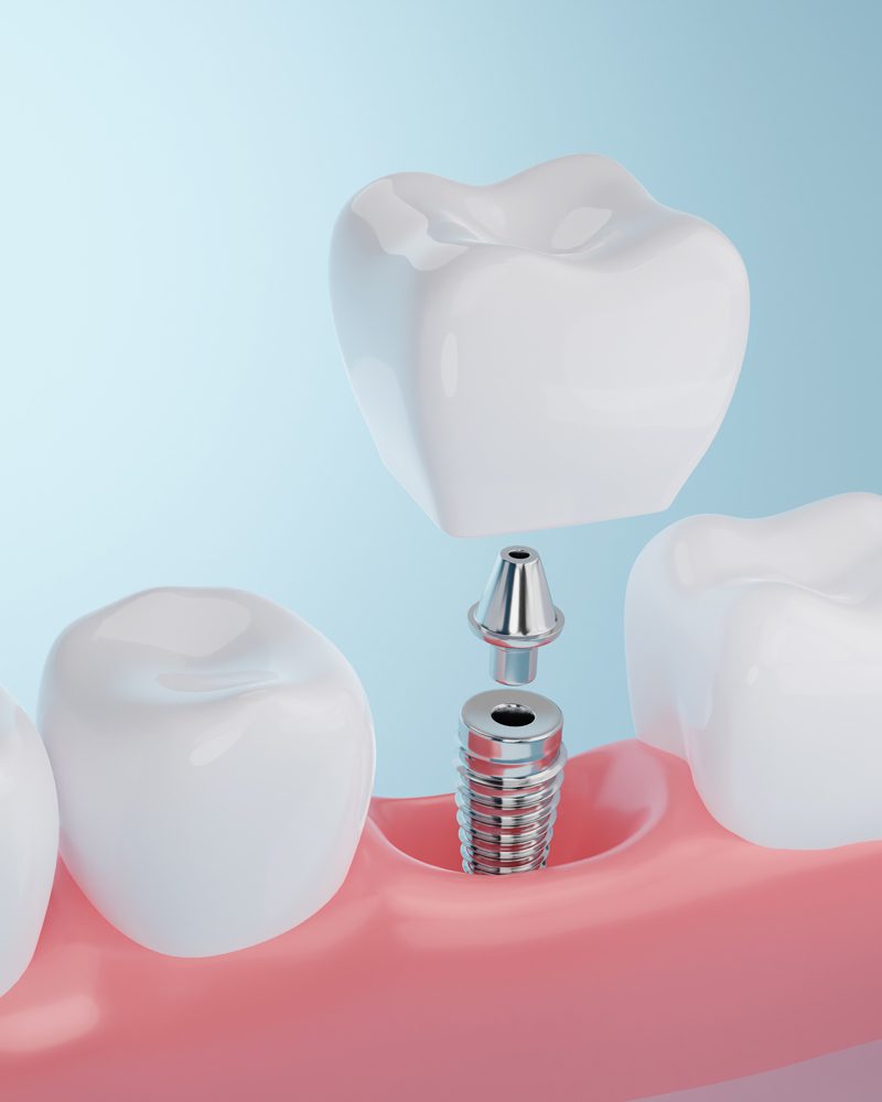 Ocala Dental Implants