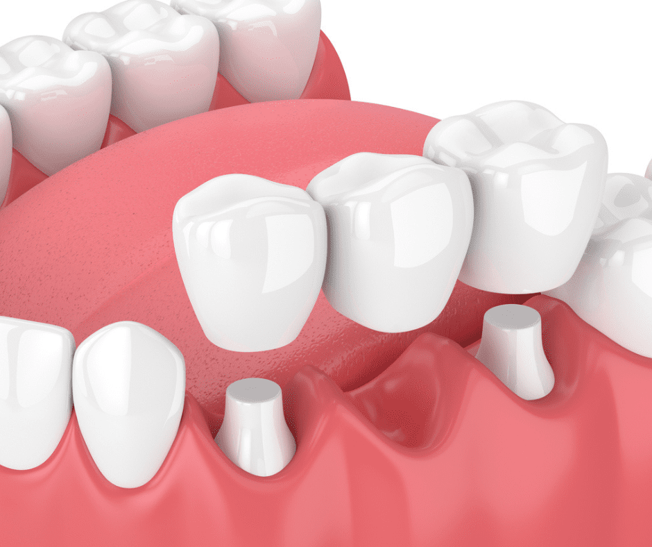 Dental Bridges in Ocala, FL