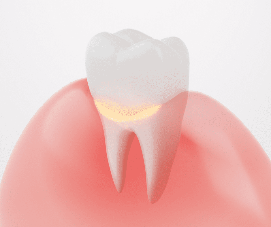 Gingivitis Treatment in Ocala Florida